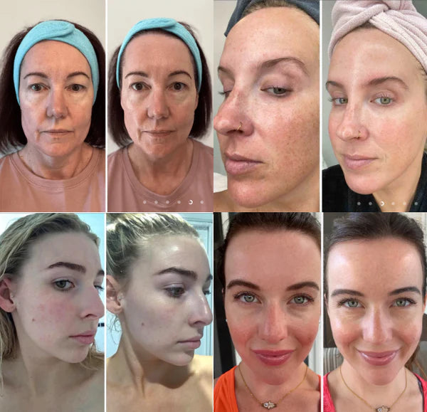 BiocollagenPlus - Máscara Absorvível de Colágeno + Ativos do Botox + BRINDE: Creme Hidratante Facial